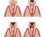 Кариес зубов: причины, лечение, виды кариеса, профилактика